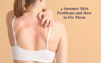 4 Summer Skin Problems And How To Fix Them
