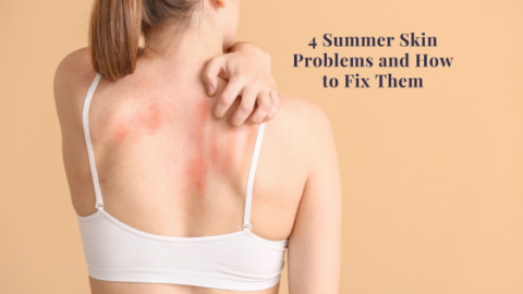 4 Summer Skin Problems And How To Fix Them | Life of Creed